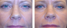 Botox