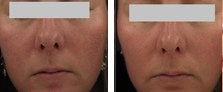 Lipolytic Injections