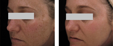 Lipolytic Injections