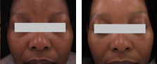 Lipolytic Injections