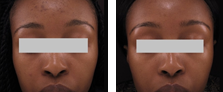 Lipolytic Injections