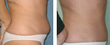 Lipolytic Injections