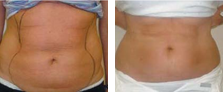 Lipolytic Injections