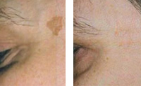 Pigmented Lesions