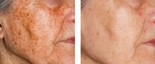 Photo Rejuvenation