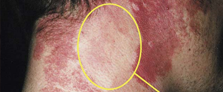 Vascular Lesions