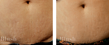Stretch Marks