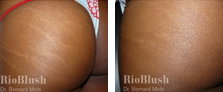 Stretch Marks