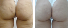 Stretch Marks