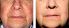 Vascular Lesions