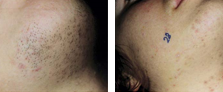 Laser Hair Removal