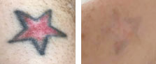 Laser Hair Removal